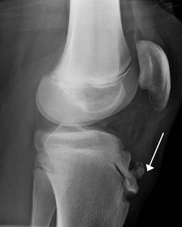sindrome di Osgood Schlatter Osgood-Schlatter