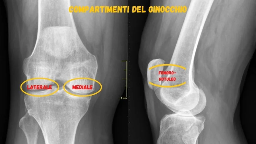 compartimenti del ginocchio