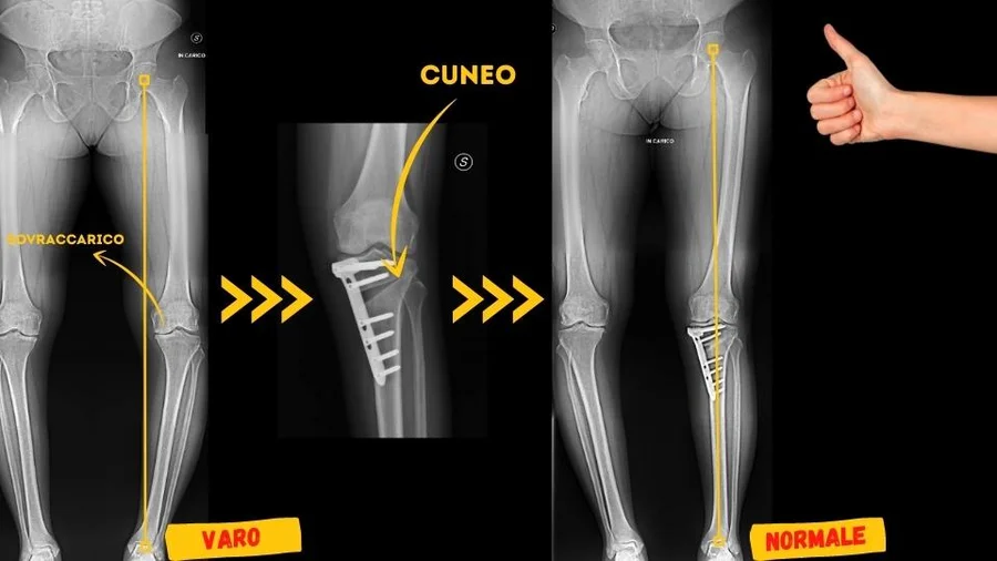 Osteotomia tibiale prossimale ginocchio varo