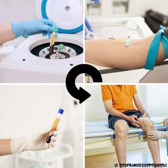 Il ciclo di preparazione del PRP: prelievo, centrifugazione, infiltrazione