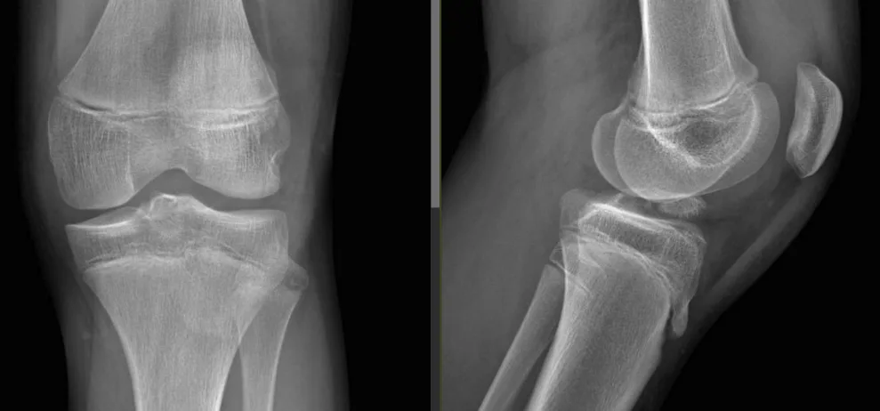Radiografia del ginocchio in proiezione antero-posteriore e laterale che mostra il distacco della spina tibiale anteriore