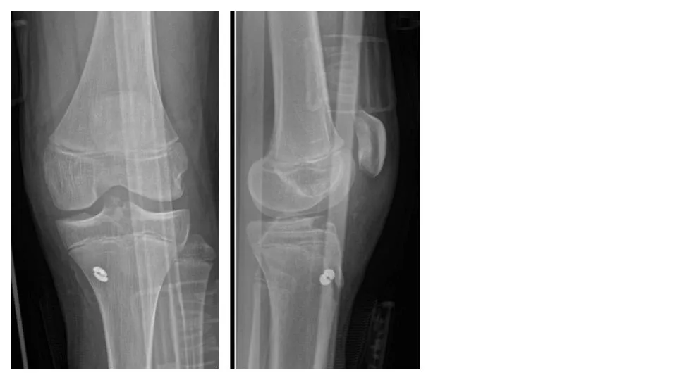Radiografia di controllo post-operatoria dopo riparazione del distacco della spina tibiale anteriore